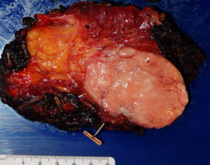 Fresh surgical tissue specimen